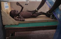UNa bambina di due anni malnutrita, nel centro di riabilitazione di Shivpuri, nel centro dell'India (foto Reuters).