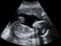 Rianimazione di feti prematuri: problemi filosofico-giuridici