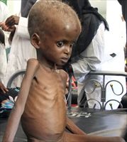 Un bambino malnutrito ricoverato all'ospedale Babadir di Mogadiscio, capitale della Somalia (foto Ap).