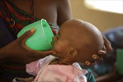 Un bambino denutrito a causa della recente carestia nel Corno d'Africa (Foto AP).